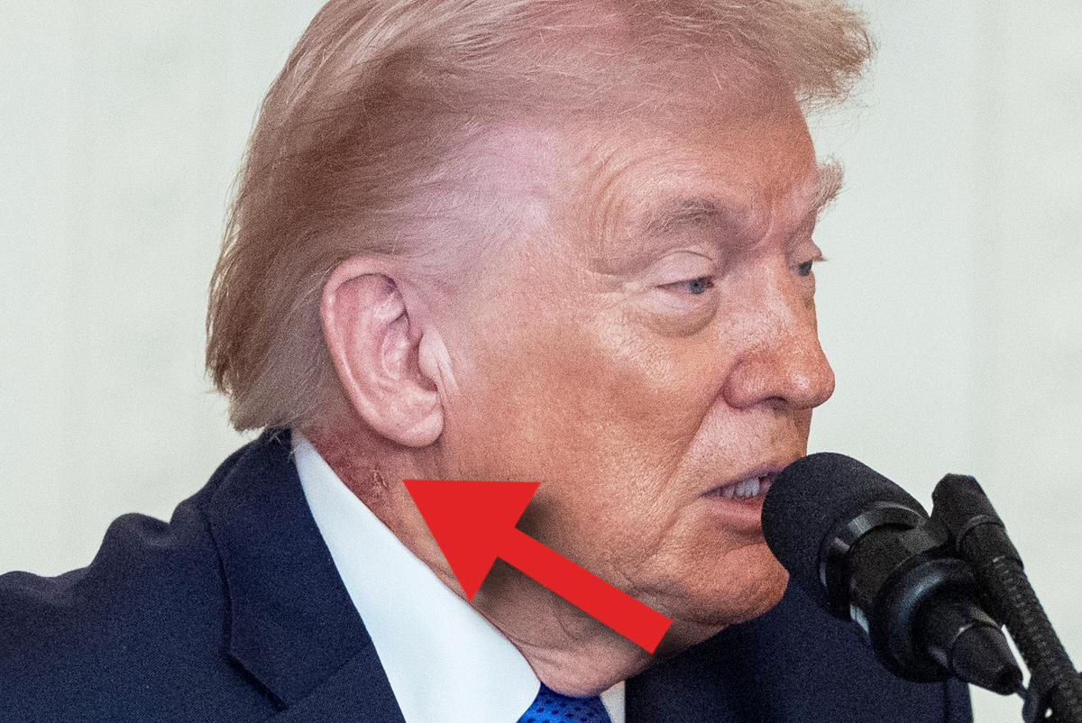 Trump's Health: New Red Spot Fuels Speculation Amid Age Concerns