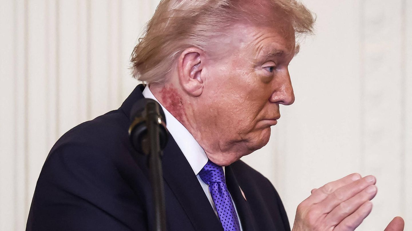 Trump's Red Neck Spot: Doctor Explains Skin Irritation